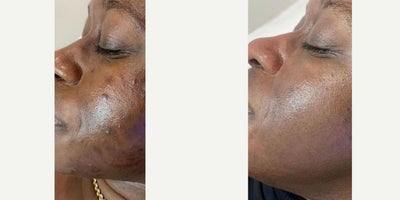 45-54 year old woman treated with Microneedling, Facial - Treated by Dr. Lisa Jukes