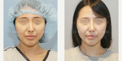 25-34 year old woman treated with Revision Rhinoplasty, DCF Rhinoplasty, Asian Rhinoplasty (1 Mo. Update) - 25-34 year old woman treated with revision DCF rhinoplasty. Patient had previously undergone primary rhinoplasty one year ago with silicone implant for the nasal bridge with rib cartilage used for the nasal tip. Her nose deviated and her nose no longer appeared straight. Patient also felt that her nose tip did not look natural. The silicone implant was removed as well as the capsule for the nasal bridge. This was replaced with a DCF graft utilizing rib cartilage and temporalis fascia. The nasal tip was reconstructed by recycling the previously placed rib grafts. The nasal tip projection was decreased slightly and a cap graft with ear cartilage was used to soften the nasal tip. The nose now appears straight with a natural appearing nasal tip.