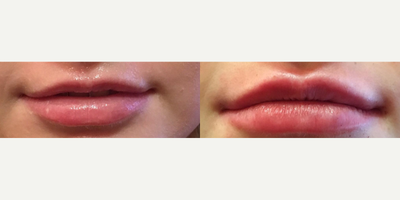 Woman treated with Lip Fillers - The holiday rumor is that kisses under the mistletoe are much better received from a fuller set of lips. Look at these fabulous results below. Call our office for a complimentary consultation to see which injectable procedure might be best for you and Happy Holidays!