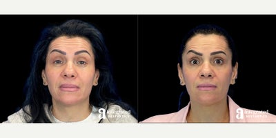 45-54 year old woman treated with Dysport - The patient is a 46-year-old female with concerns about fine lines and wrinkles. Dr. Chiang used wrinkle relaxer (Dysport or Chotox) for the forehead, crow's feet, bunny lines, masseters, and neck bands to address these concerns. The after results are 2 weeks post-treatment.