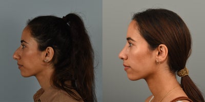 25-34 year old woman treated with Rhinoplasty - 28 year old interested in smoothing dorsal hump and refining the nasal tip.