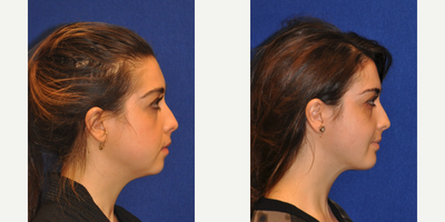 Chin Implant - Chin Implant