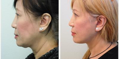 50+ year old Asian woman treated with Neck Lift - This Asian female patient came to us for consultation to address the sagging tissue under her chin and loss of profile. Together we decided to perform a necklift. We removed the fat under chin and tightened the underlying platysma muscle both underneath the chin and from behind the ears. The procedure was performed comfortably under local anesthesia (with mild oral sedation) in our center. Her result is a significantly more defined jawline and profile while maintaining a natural appearance.
