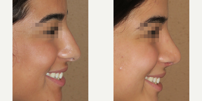 Woman treated with Rhinoplasty - Woman treated with Rhinoplasty- 2 months post-op