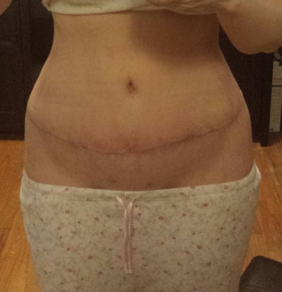 tummy tuck scars after 5 years
