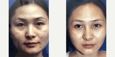 Woman treated with Jaw Reduction - Woman treated with Jaw Reduction