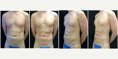 35-44 year old man treated with Abdominal Etching - Abdominal Etching