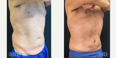 45-54 year old man treated with Skin Tightening, - Dr. Ko performed Liposuction and Skin Tightening on this patient. Skin MD is the #1 provider of InMode's BodyTite, FaceTite + Morpheus in Massachusetts - 2022.