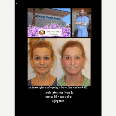 55-64 year old woman treated with Facelift - These photos demonstrate a female patient 24 hours after undergoing a lower face and neck lift. This patient is bruising and swelling is mild. The amount of bruising and swelling does vary between individuals.
