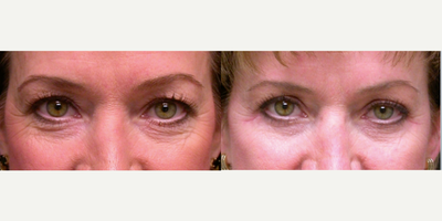 35-44 year old woman treated with Eyelid Surgery - 41 year old female treated with lower blepharoplasty.