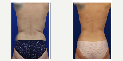 45-54 year old woman treated with 360 liposuction, renuvion and breast reduction. - This patient underwent 360 liposuction with renuvion and breast reduction. She's 3 months out and loves her enhanced contours and more proportional breast size.