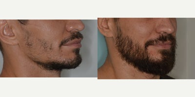 35-44 year old man treated with Beard Transplant, FUE Hair Transplant - Before and after 1800 FUE to beard