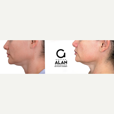 35-44 year old woman treated with Radiesse - The application of Radiesse is performed with personalized techniques to restore or give volume and elasticity in a natural way to the folds and deep wrinkles that present in the skin. The results are progressive, they are seen from its application but after 15 days the final result is reflected.