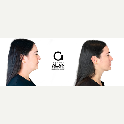 25-34 year old woman treated with Nonsurgical Facelift - Lift-!N is the latest HIFU (High-Intensity Focused Ultrasound) aesthetic technology that focuses all its energy in a high frequency ultrasound beam to a specific area of the skin, without making incisions or using needles on the patient, in order to reshape their tissue by thermal ablation.