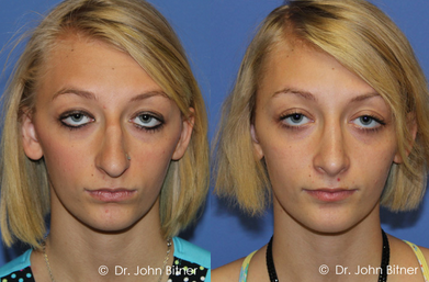 Rhinoplasty -
Rhinoplasty