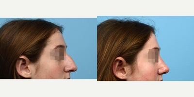 18-24 year old woman treated with Septoplasty - Looking for a natural rhinoplasty result, this patient turned to Dr. Wise. Two months after her nose surgery, she loves the new look and appreciates her ability to breathe better.