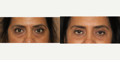 45-54 year old woman treated with Eyelid Surgery - lower blepharoplasty
