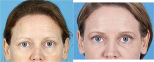 35 yo female with sunken eyes acne scar - CO2 fractional laser fillers juvederm sunken eyes acne scar Barrera