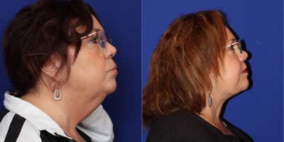 55-64 year old woman treated with Neck Lift - Neck lift with liposculpture