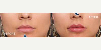 Woman treated with Lip Fillers - Woman treated with Lip Fillers
