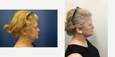55-64 year old woman treated with Facelift - Facelift and Necklift using High SMAS technique and Platysmalplasty
