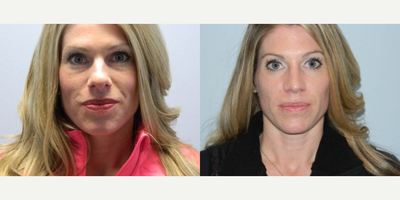 Woman treated with Rhinoplasty - Before and 3 months after a reduction rhinoplasty for a very bulbous, overprojected tip with wide nostrils and a wide bridge. In the after photos you can see how the tip was refined and narrowed. Also, you can see that the bridge and nostrils were refined and narrowed to give a much more feminine and prettier nose.