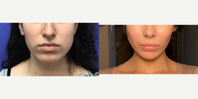 Patient treated with Facial Fat Transfer - Soft Tissue to Nasolabial Folds - 18 to 24 year-old female patient is 1 month post-op from Facial Feminization surgery. Her procedures included: Forehead Lift, Hairline Lowering, Orbital Bony Contouring, Septorhinoplasty (closed) with Cartilage Grafts, Cheek Implants (small), Chin Implant (central) with Reduction and Contour, Soft Tissue to Nasolabial Folds, Intranasal Lip Lift with Fascia to Lips and 300 Micrografts to Recessions.