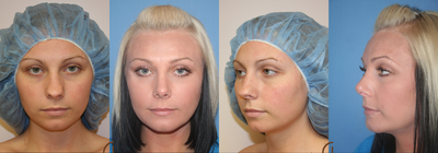 Rhinoplasty -
Revision rhinoplasty and chin augmentation