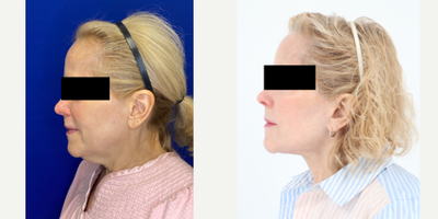 65-74 year old woman treated with Facelift, Neck Lift, Facial Fat Transfer, CO2 Laser - 73 year old patient 2 years after Facelift, Neck lift, Facial Fat Transfer and CO2 laser