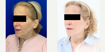 65-74 year old woman treated with Facelift, Neck Lift, Facial Fat Transfer, CO2 Laser - 73 year old patient 2 years after Facelift, Neck lift, Facial Fat Transfer and CO2 laser