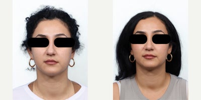 34 year old woman treated with Rhinoplasty - This 34 year old female patient sought rhinoplasty to address a dorsal hump and a crooked nasal profile resulting from a previous nasal fracture sustained in her youth. The procedure refined the nasal bridge, straightened the profile, and restored balance and harmony to her facial features. Her results highlight a smoother, more symmetrical contour while maintaining a natural appearance.