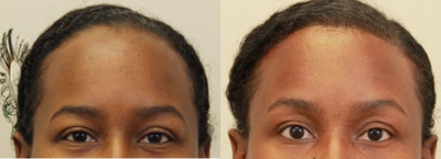 35-44 year old woman treated with Forehead Reduction - 37 year old treated with forehead reduction/ hairline lowering