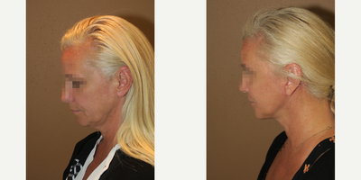 45-54 year old woman treated with Facelift - face lift