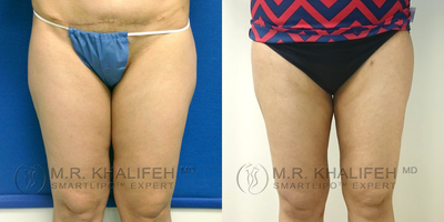 35-44 year old woman treated with Tumescent Liposuction - The inner thighs are a major cause of concern for many of our patients. a typical treatment will place incisions in the front of the groin and in the butt fold from behind, to make sure we get front and back.