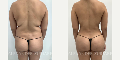 31 year old woman treated with Brazilian Butt Lift - 31 year old woman treated with Brazilian Butt Lift