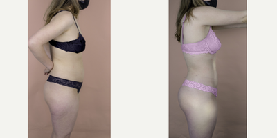 25-34 year old woman treated with Liposuction - This wonderful patient is shown 2-months post-op from 360 Liposuction. She was able to achieve a smaller waistline and an amazing hourglass shape.