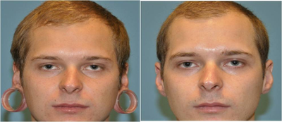 Ear Gauge Repair - Before and After Ear Gauge Repair.
