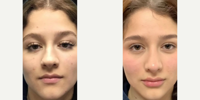 Woman treated with Rhinoplasty - This patient is now 4 Months Post-Op from her Rhinoplasty procedure! This patient came in wanting to reduce her bump & slim out her nosesubtle changes that make a difference!