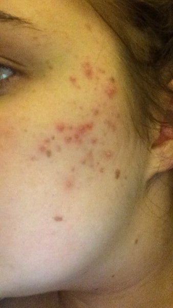 I Have Red Blotches On My Face Any Suggestions For Treatment Photos