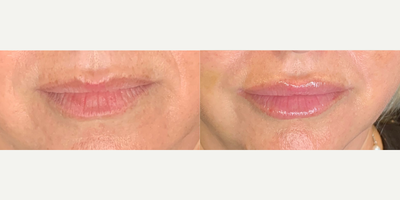 45-54 year old woman treated with Lip Fillers - Lip filler to slightly increase volume of lips and fill in fine lines.