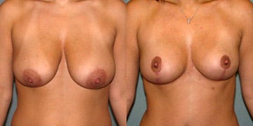 Breast Lift