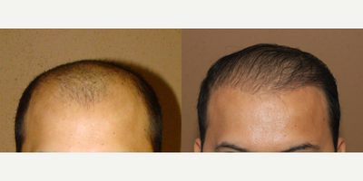 35-44 year old man treated with Hair Transplant - ARTAS transplant, 2500 units