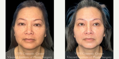 45-54 year old woman treated with CoolPeel, Skin Lightening, CO2 Laser, Skin Rejuvenation, IPL - This patient underwent a single combination treatment of CoolPeel laser skin resurfacing and the Elluminate Advanced Photofacial (with IPL) to brighten dull skin, soften sun damage, and improve overall facial clarity.Her after photos show a noticeably more radiant complexion with improved skin tone, smoother texture, and reduced pigmentation irregularities across the cheeks, forehead, and under-eye area. Fine lines appear softer, pores look more refined, and the overall surface of the skin appears healthier and more even.CoolPeel works by delivering controlled, superficial CO resurfacing with minimal downtime, while the Elluminate Photofacial targets multiple layers of discolorationfrom sun spots to rednessto produce a clearer, more luminous complexion. Together, these technologies complement one another to deliver a refreshed, rejuvenated look in just one session.This combination treatment is ideal for patients who want visible brightening and smoothing benefits with little to no downtime and a naturally refreshed appearance.