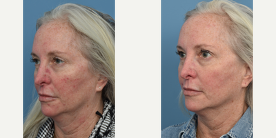 55-64 year old woman treated with IPL - This patient was concerned with Rosacea and Acne. She was treated with IPL and ZO Acne Control treatments.