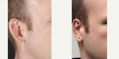 35-44 year old man treated with Ear Surgery - He is always teased about how the ears flared out like 2 open car doors. Ear cartilage excision and re-suturing to fold the ears back and re-create the upper ridge are achieved.