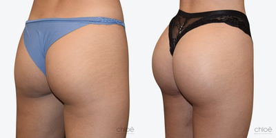 Non Surgical Butt Lift using Sculptra - It is now possible to have a butt augmentation without surgery using sculptra injections.