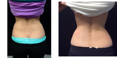 27 year old woman treated with CoolSculpting/ Flanks - 27 year old woman treated with CoolSculpting/Flanks