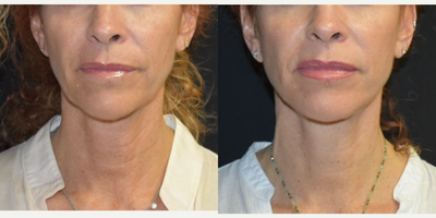 Woman treated with Facelift - Woman treated with Facelift