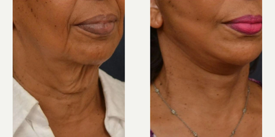 Woman treated with Facelift - LOWER FACELIFT