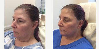 55-64 year old woman treated with Radiesse Dermal Filler to the Cheeks, Chin, Jawline - Patient wanted to enhance her natural features while also addressing volume loss. Radiesse filler was injected to the Cheeks, Chin and Jawline.